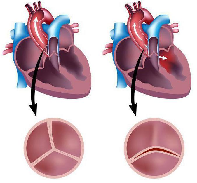 аортальный двустворчатый клапан